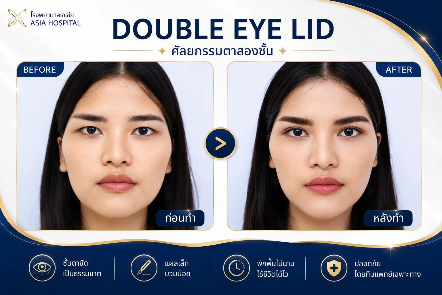 ศัลยกรรมตา ก่อน-หลัง