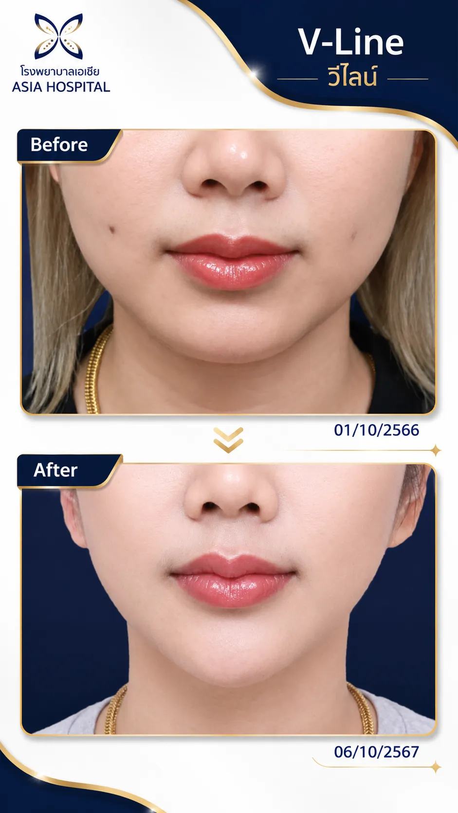 ศัลยกรรมใบหน้า ก่อน-หลัง