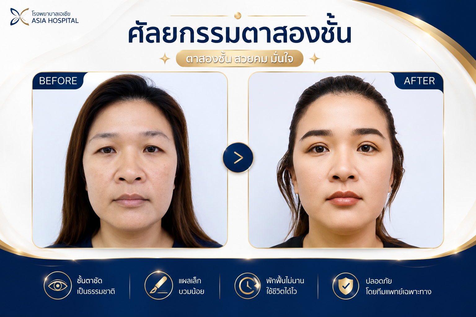 ศัลยกรรมตา ก่อน-หลัง