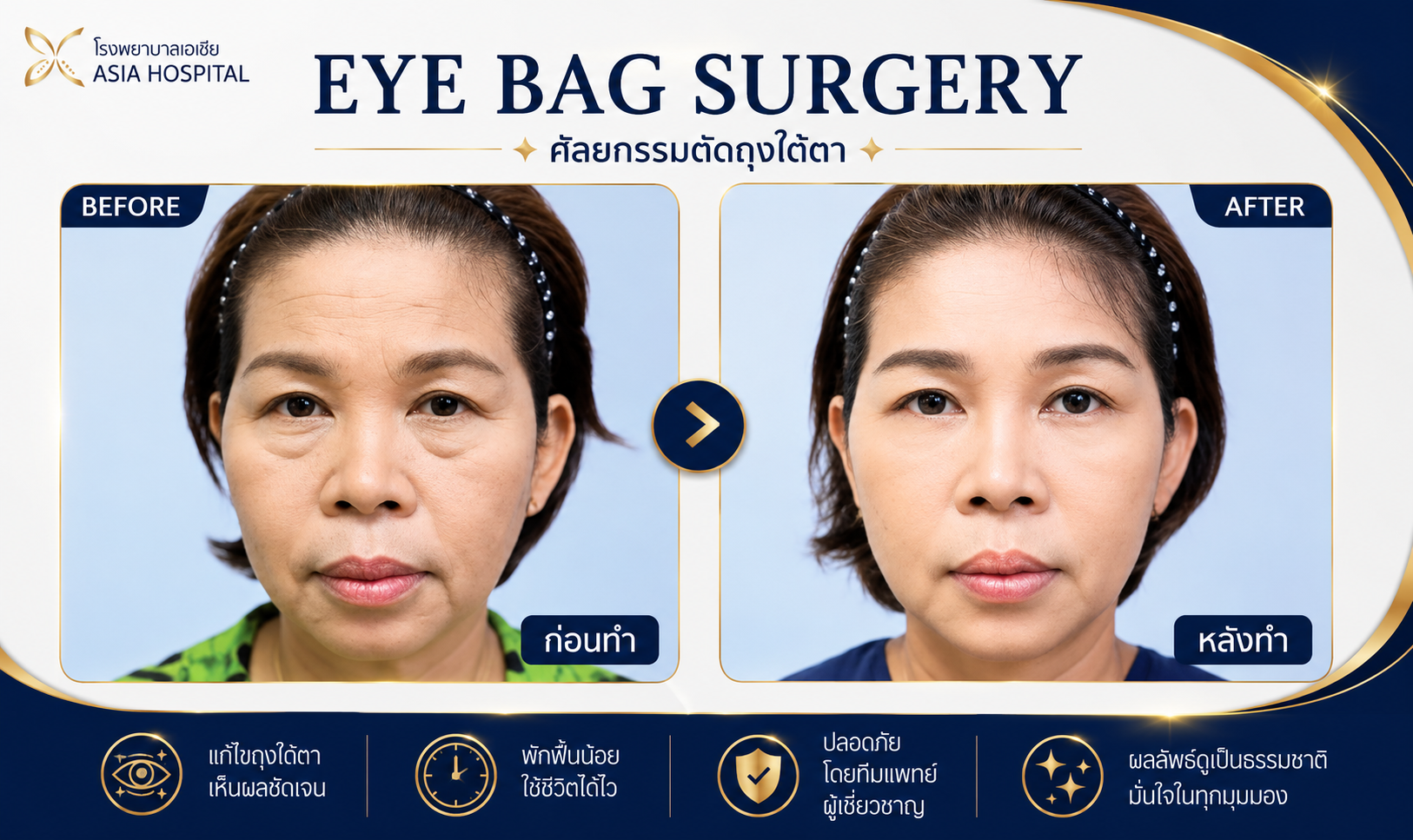 ก่อน-หลัง ศัลยกรรมตา