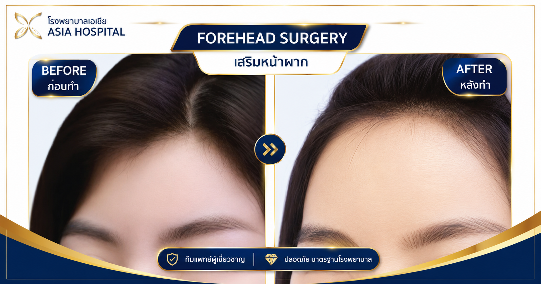ก่อน-หลัง ศัลยกรรมใบหน้า