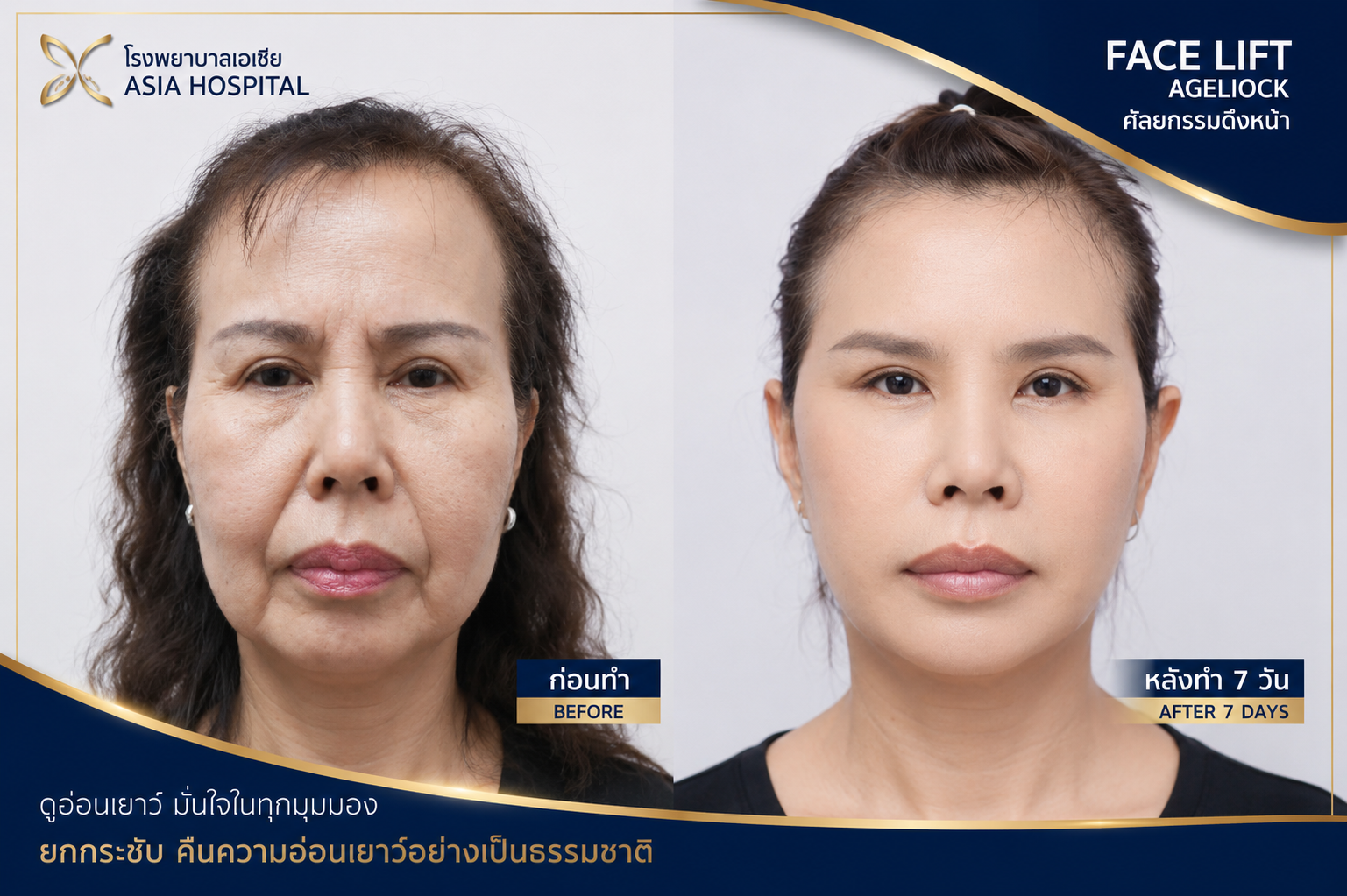 ก่อน-หลัง ศัลยกรรมดึงหน้า