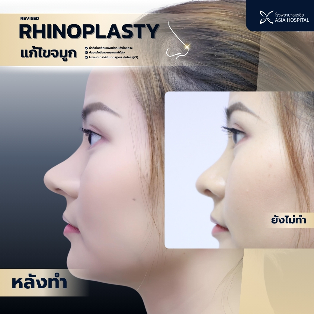 ศัลยกรรมจมูก ก่อน-หลัง