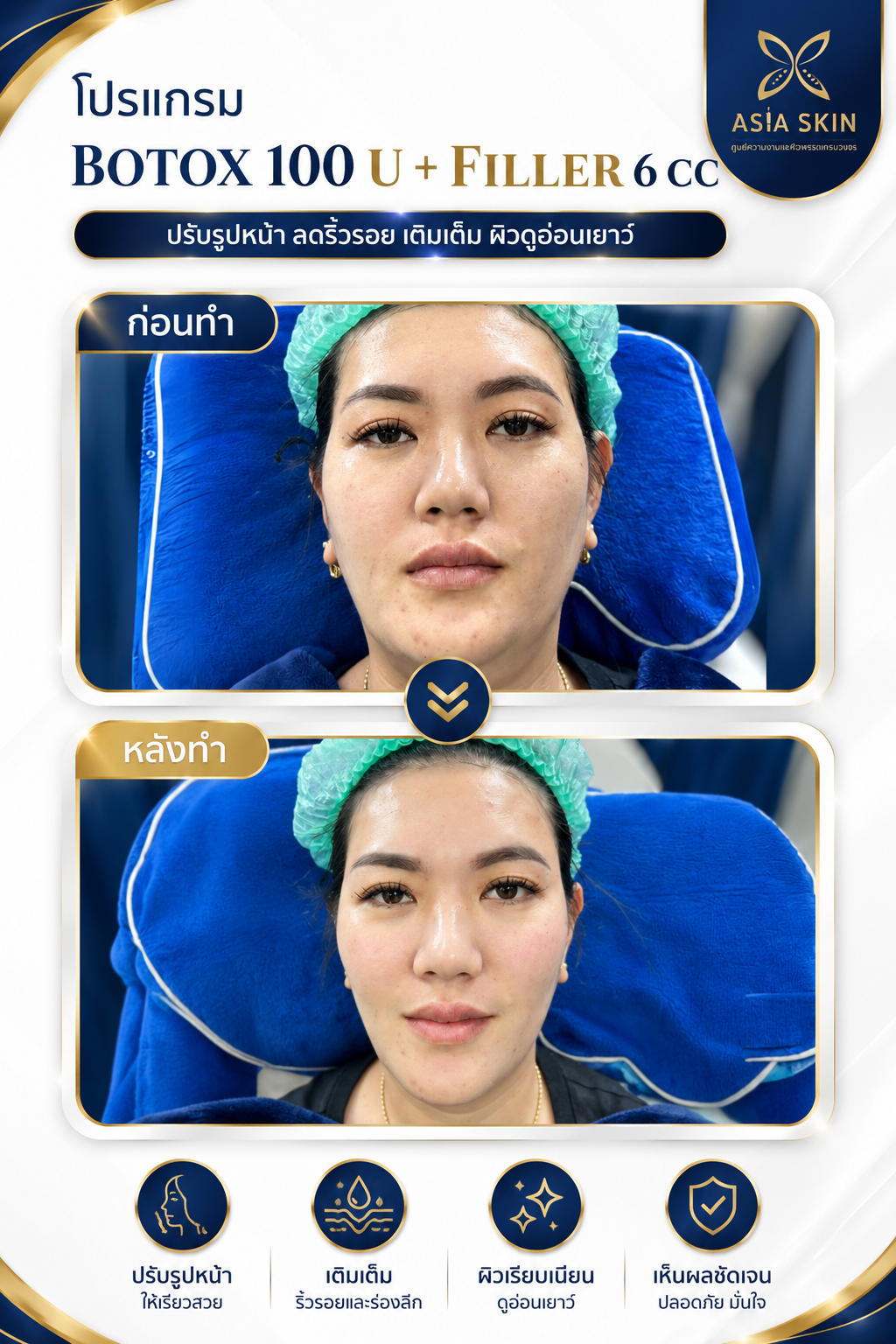 ฉีดหน้า (ผิวพรรณ) ก่อน-หลัง
