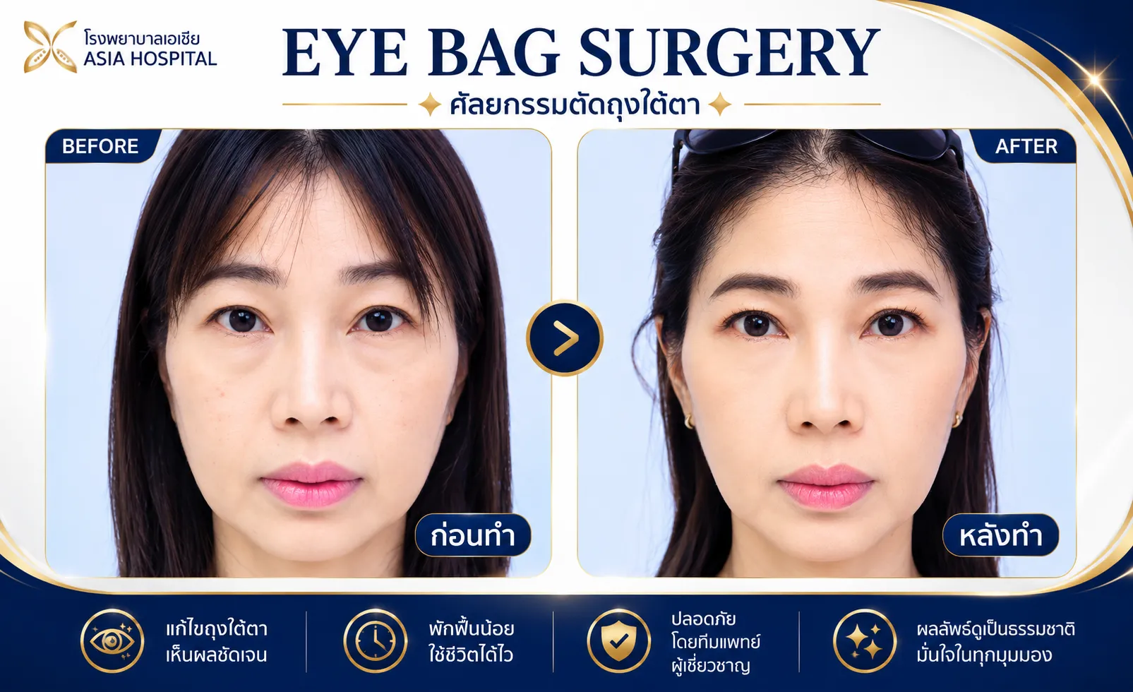 ศัลยกรรมตา ก่อน-หลัง