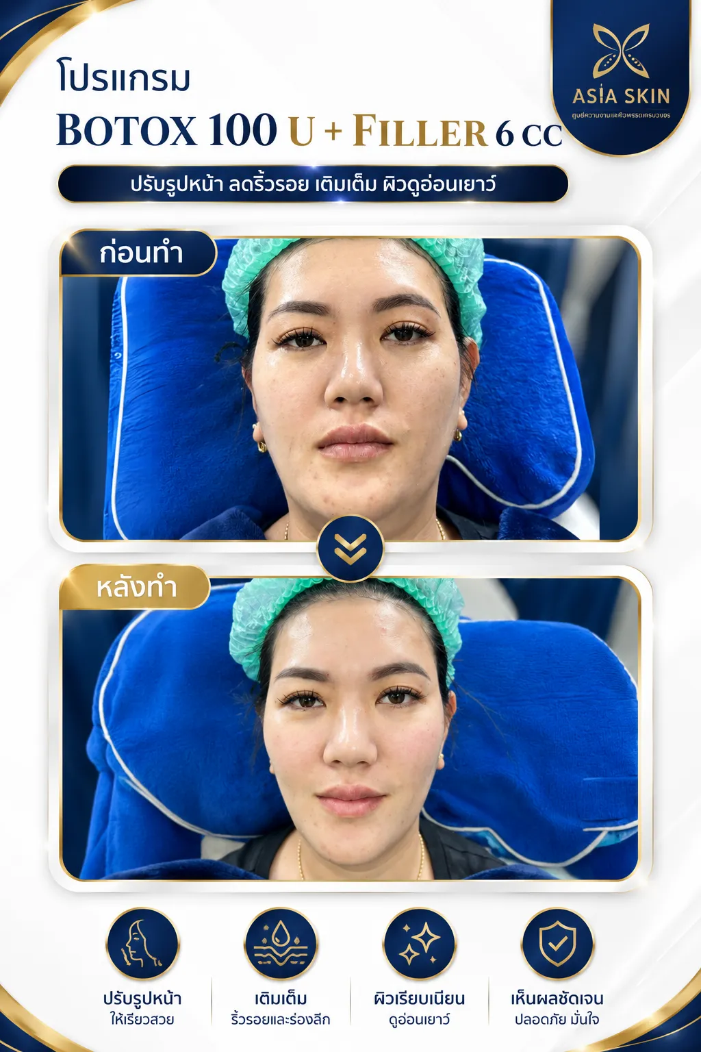 ศัลยกรรมใบหน้า ก่อน-หลัง